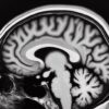 Cientistas casos transmissão Alzheimer