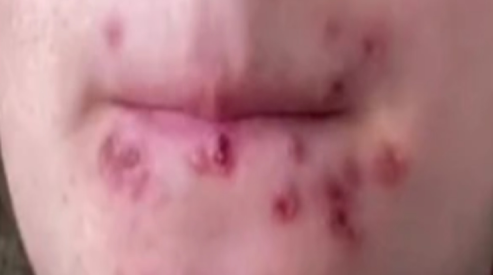 Herpes demência