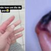SP Homem picado aranha dedo amputado