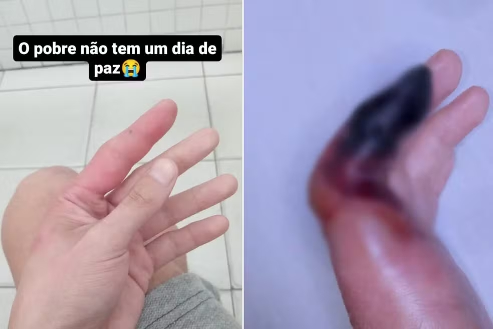 SP Homem picado aranha dedo amputado