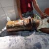 Menino de 2 anos fica com a cabeça presa em tubo de aço em Alagoas