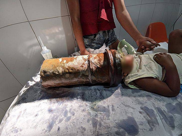 Menino de 2 anos fica com a cabeça presa em tubo de aço em Alagoas