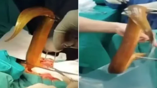 Homem enfia enguia viva de 60 cm no ânus e precisa passar por cirurgia após animal começar a comê-lo por dentro