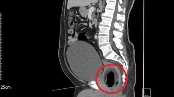 Homem de 56 anos faz cirurgia para extração de um coco de 9 cm no ânus