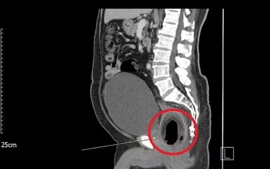 Homem de 56 anos faz cirurgia para extração de um coco de 9 cm no ânus