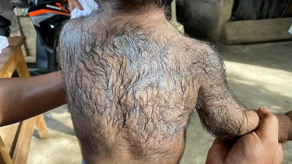 'síndrome do lobisomem' em Bebês