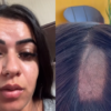 cabelo raspado durante exame toxicológico