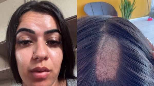 cabelo raspado durante exame toxicológico
