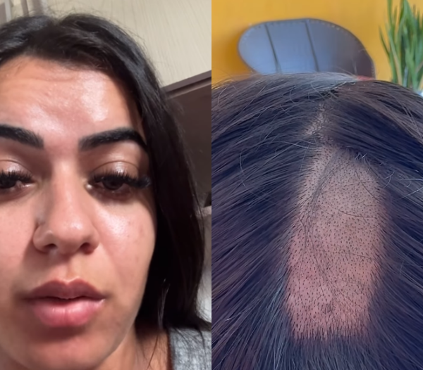 cabelo raspado durante exame toxicológico