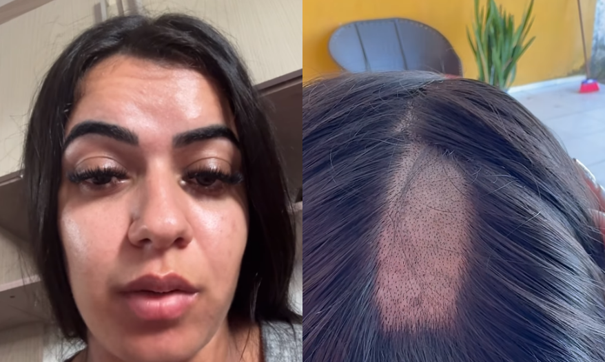 cabelo raspado durante exame toxicológico