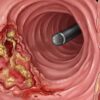 câncer de intestino