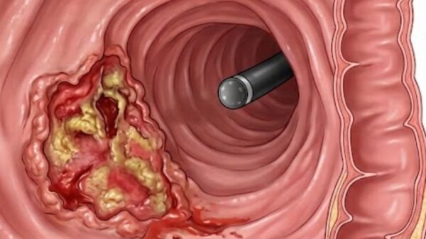 câncer de intestino