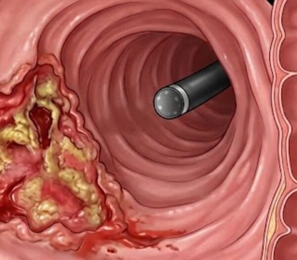 câncer de intestino