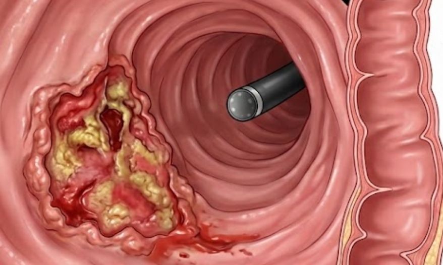 Conheça os sinais do câncer de intestino que parecem inofensivos, mas não devem ser ignorados